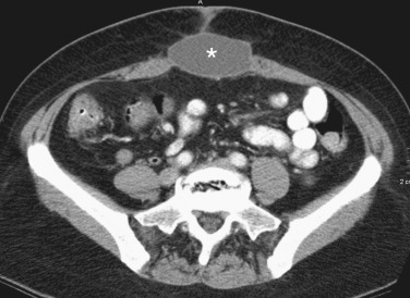 Figure 83-10, Abdominal wall seroma. Axial contrast-enhanced computed tomography image of the abdomen demonstrating a homogeneous fluid collection in the midline anterior abdominal wall (asterisk) in a 42-year-old woman after left colectomy. Note the homogeneous density of the fluid collection and absence of inflammatory changes in adjacent subcutaneous tissue.