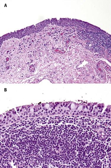 FIGURE 19-1, Chronic conjunctivitis. A, Conjunctival mucosa with focal bandlike lymphoplasmacellular infiltrate. B, Dense infiltrate of lymphocytes and plasma cells.