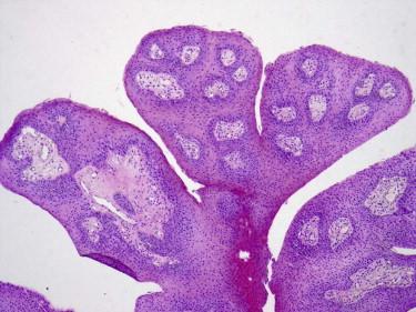 FIGURE 19-15, Squamous papilloma. Papillomatous epithelial growth with fibrovascular cores.