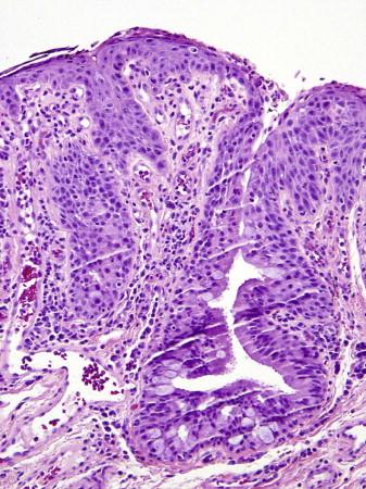 FIGURE 19-2, Chronic conjunctivitis with squamous metaplasia.