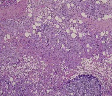 FIGURE 19-7, Lymphogranulomatous reaction with focal mild vascular damage.