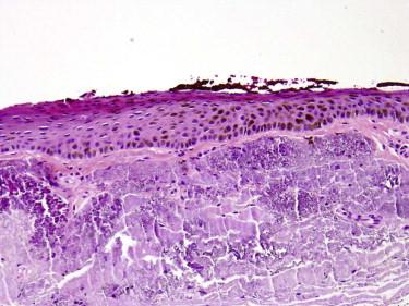 FIGURE 19-8, Atrophic conjunctival mucosa with marked stromal solar elastosis.