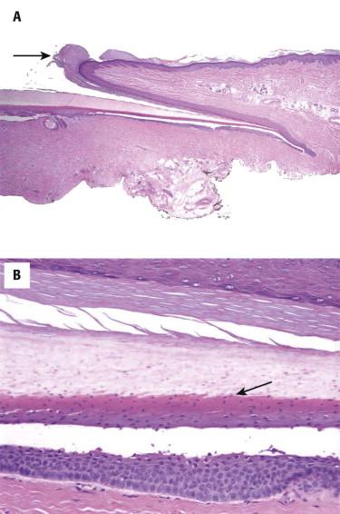 FIGURE 18-2, Microscopic features of the proximal nail unit. A, Nail fold (arrow) and nail matrix (with incidental subungual epidermoid inclusion). B, Ventral surface of proximal nail fold (eponychium) with granular cell layer on top and matrix epithelium at the bottom. In between is the keratogenous zone (arrow) nail plate (asterisk).