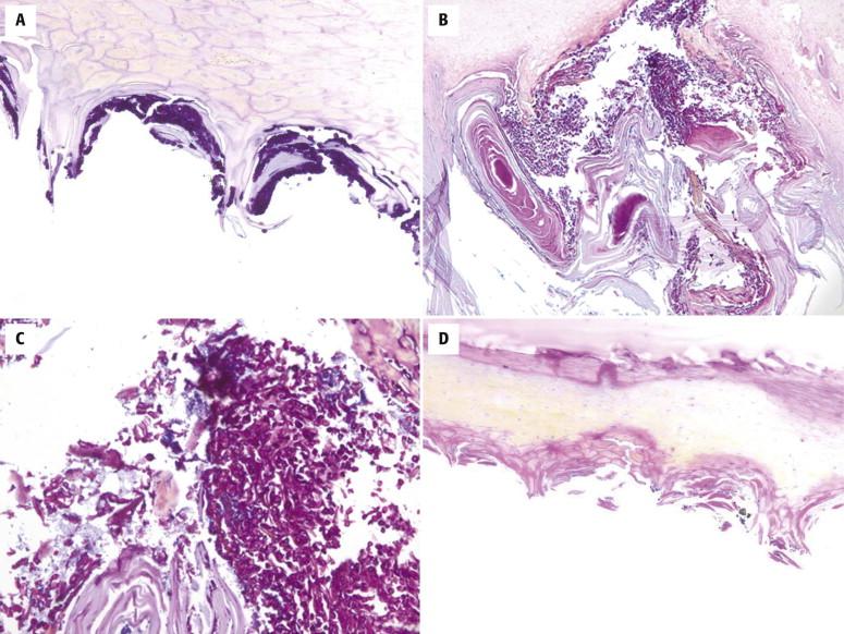 FIGURE 18-5, A, Candidal onychomycosis, featuring small spores and pseudophyphae on the undersurface of the nail plate (periodic acid-Schiff with diastase digestion [PAS-D] stain). B and C, Dermatophytoma, a loculated mass of fungi or mold and bacteria, representing a recalcitrant form of onychomycosis (PAS-D stain). D, Pseudomonas infection, with the typical lemon-yellow hue of the nail plate caused by diffusible fluorescein pigment produced by the bacterium.