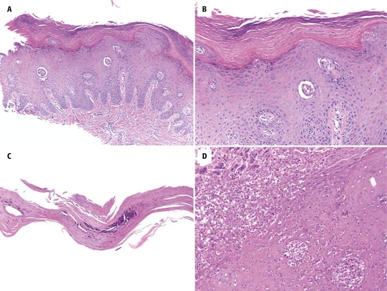 FIGURE 18-8, Nail bed psoriasis. A, Epithelial hyperplasia, hyper- and parakeratosis with scattered neutrophils, and dilated superficial dermal vessels. B, Hypergranulosis and dilated vessel in papillary dermis. C, Detached cornified material with neutrophils and parakeratosis. D, Pustular psoriasis of nail bed from a patient who had onycholysis, with many neutrophils within the epithelium, forming spongiform pustules.