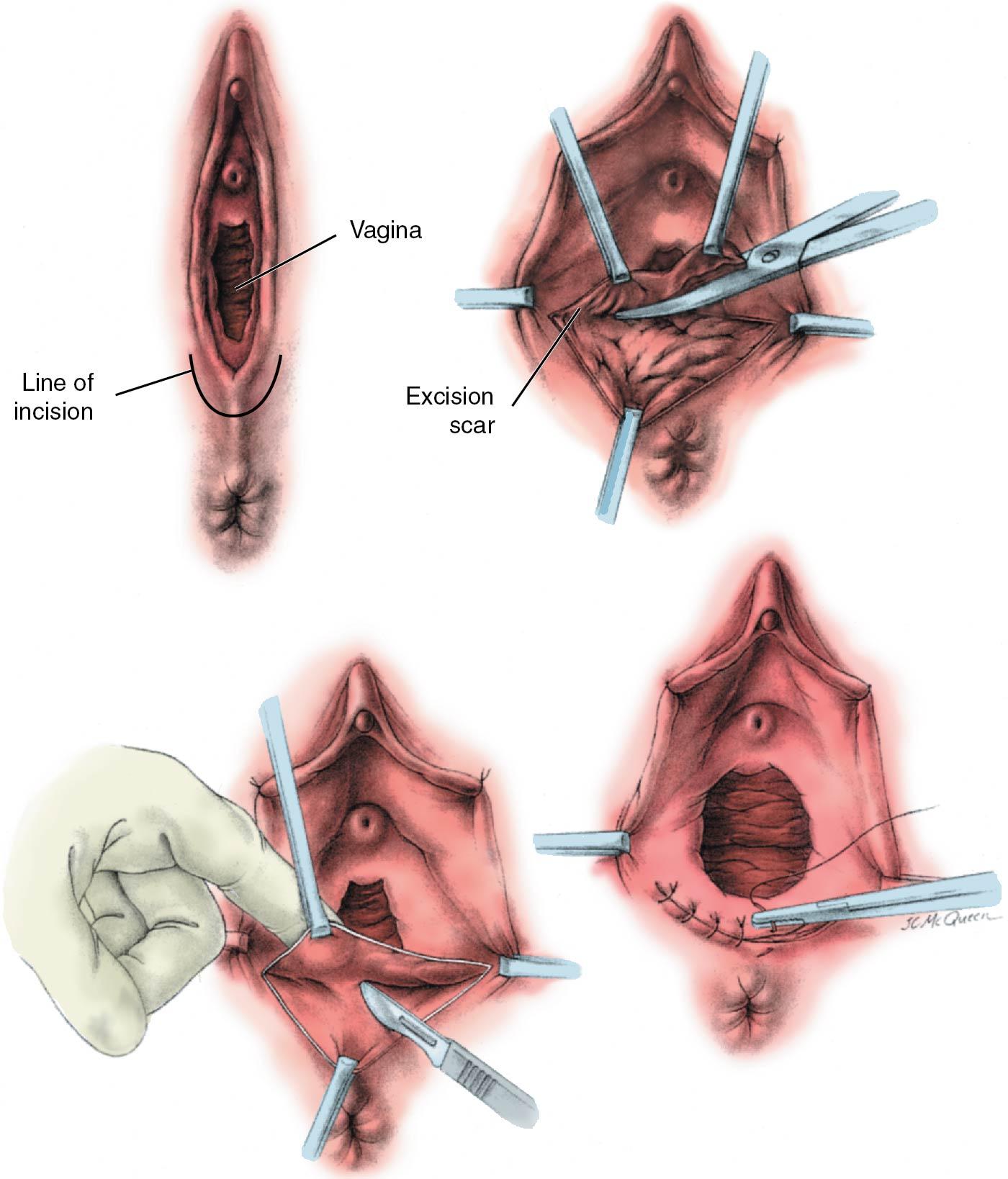 Fig. 30.11, Surgical correction of perineal scars.