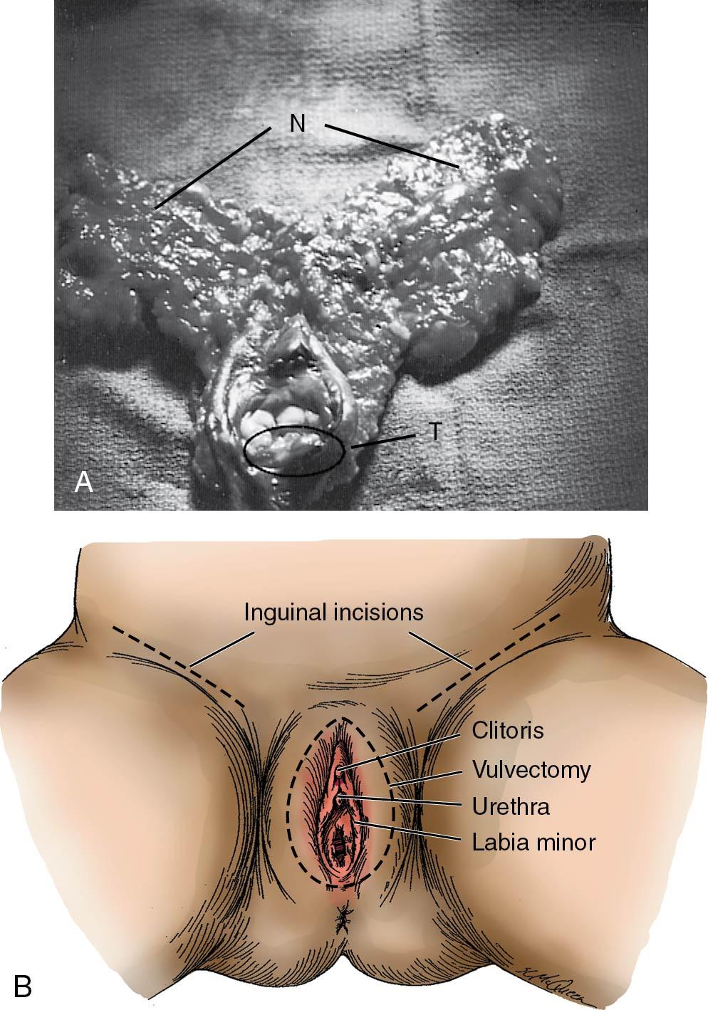 Fig. 30.12, A, Radical vulvectomy specimen. B, Vulvectomy with operative incision lines shown. Note groin incisions.