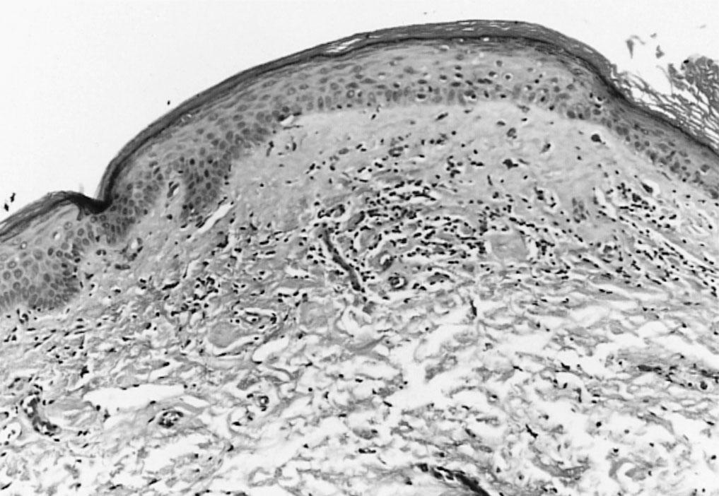 Fig. 30.2, Lichen sclerosus et atrophicus. Homogeneous collagen in the papillary dermis is accompanied by a scattered lymphocytic infiltrate and atrophy of the epithelium (hematoxylin and eosin stain, ×80).