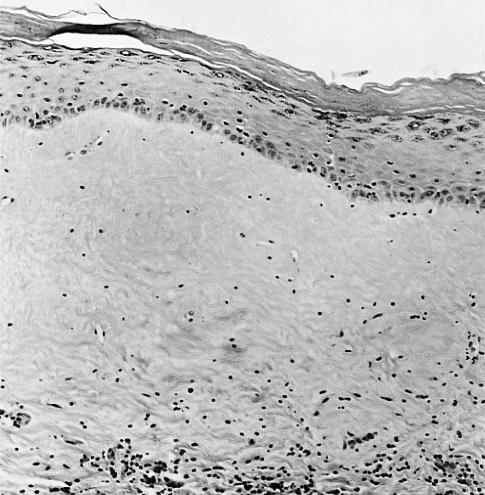 Fig. 30.3, Lichen sclerosus. Hyperkeratosis is occasionally present.