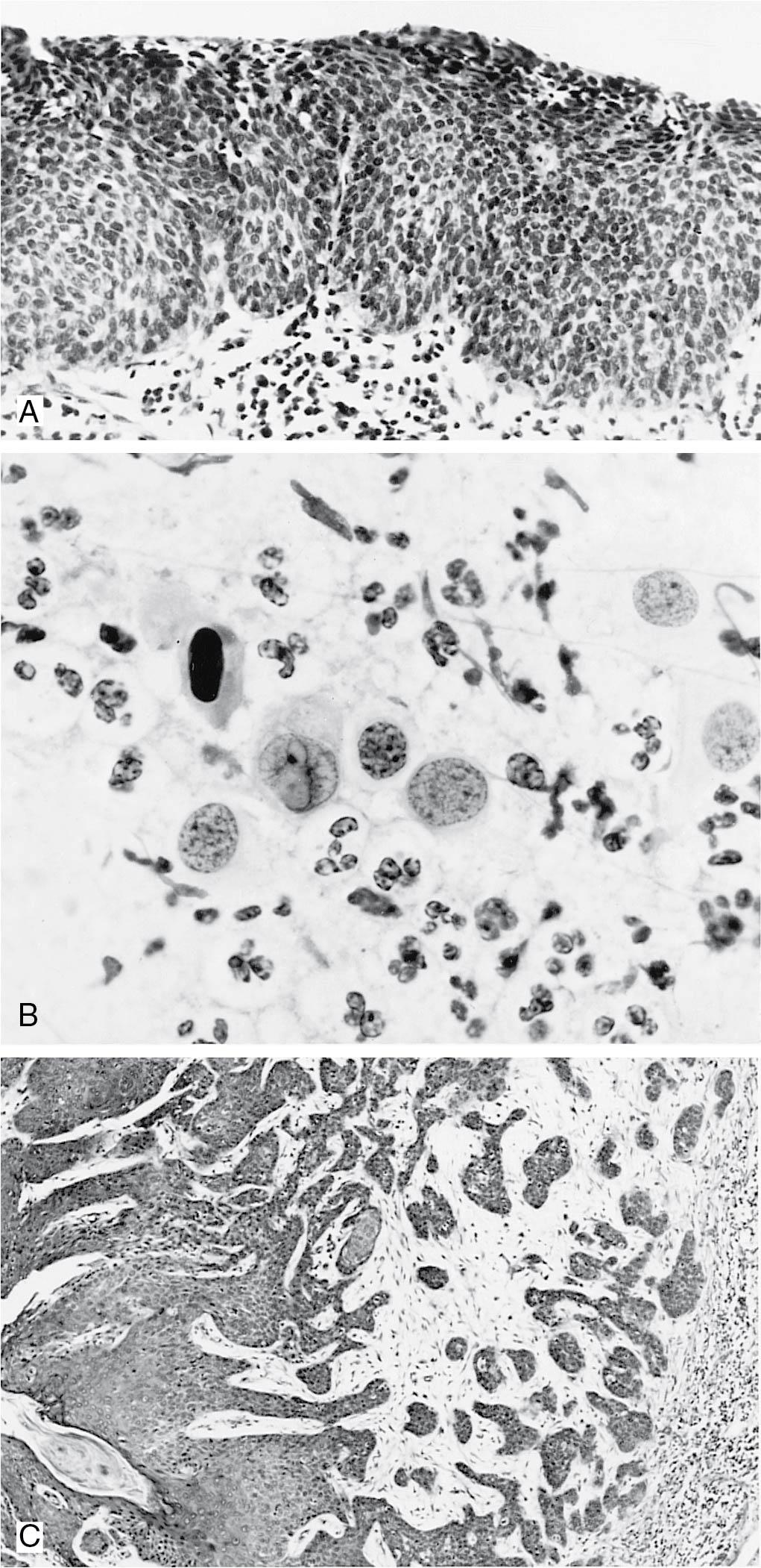 Fig. 30.6, A, Carcinoma in situ, histology. The full thickness of the epithelium is replaced by hyperchromatic cells with poorly defined cellular borders (×80). B, Carcinoma in situ, cytology. Cells derived from carcinoma in situ of the vulva may exhibit varying sizes and shapes, as depicted in this photomicrograph. Note variation in nuclear pattern from one nucleus to another. Degenerated polymorphonuclear leukocytes are present in the background (×800). C, Invasive squamous carcinoma, histology. Tumor nests and cords infiltrate stroma. The squamous nature of the tumor is more apparent on surface (left), where cells have abundant dense cytoplasm. Keratin is also seen (×80).