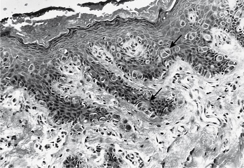 Fig. 30.7, Vulvar epidermis with Paget disease. Malignant cells (arrows) are seen infiltrating the epidermis and spreading along the dermal-epidermal junction (hematoxylin and eosin stain, ×160).