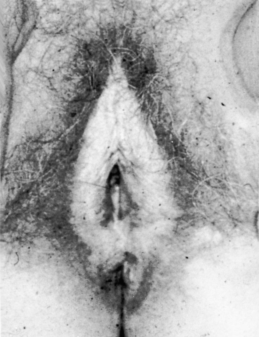 Fig. 30.8, Vulva, lichen sclerosus. The tissue of the labia minora and perineum have a white, brittle, cigarette paper appearance.