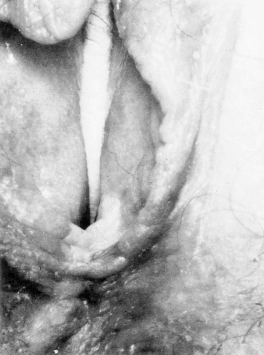 Fig. 30.9, Vulva, hyperplastic dystrophy. A sharply demarcated, raised, white area is noted at lower tip of white pointer.