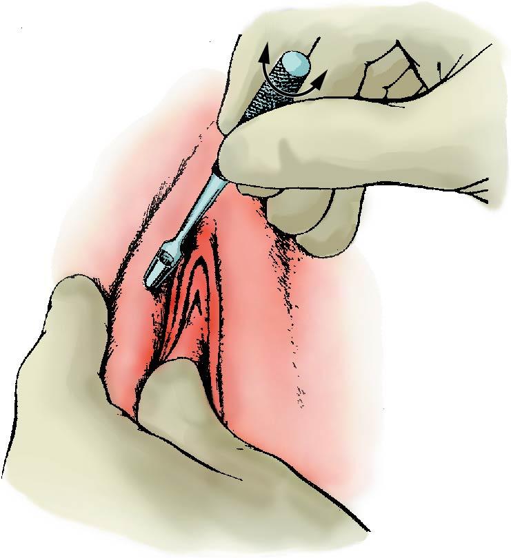 Fig. 30.10, Diagnostic Keyes punch biopsy.