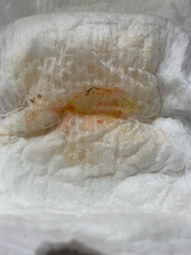 Fig. 14.1, A diaper from an infant with pink diaper syndrome.