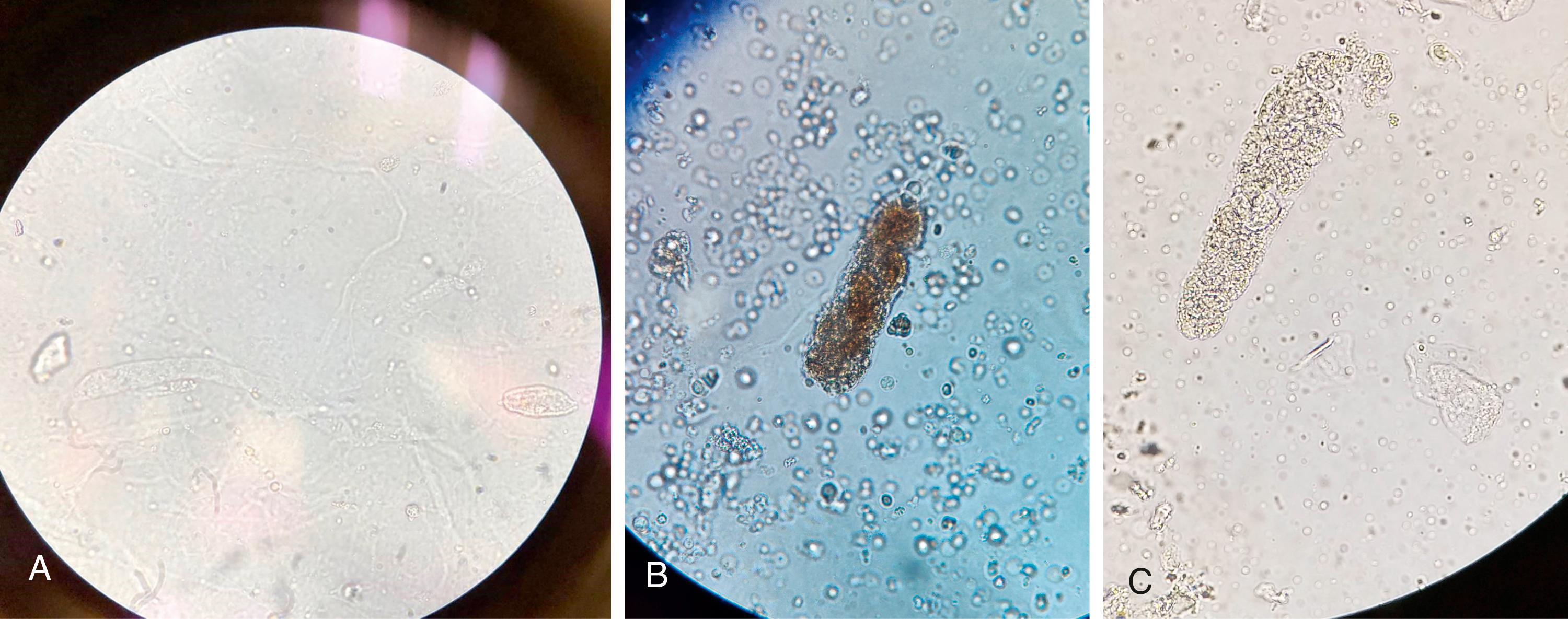 Fig. 14.4, (A) Hyaline cast, which may be seen in low urinary flow state and can be a nonpathological finding or it can be seen with other pathological casts. (B) Red blood cell casts and (C) white blood cell casts, which can be seen with acute and chronic glomerulonephritis.