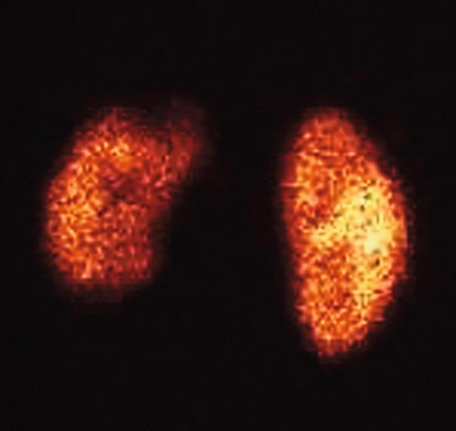 Fig. 20.2, DMSA scan (posterior view) showing parenchymal defects (scaring) of the left kidney.