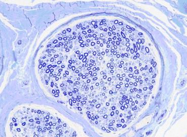 Figure 5.1, Semi-thin section of peripheral nerve showing epineurium, perineurium, and endoneurium. The nerve has a normal complement of large and smaller myelinated fibers (toluidine blue).