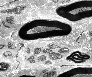 Figure 5.2, Electron micrograph showing myelinated and unmyelinated fibers.