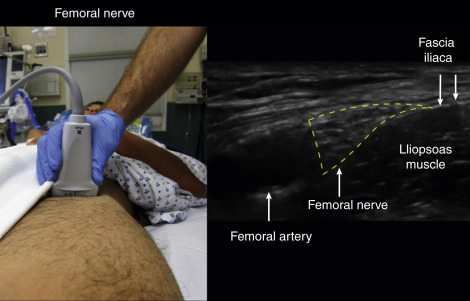 Fig. 31.1, The femoral nerve can often easily be visualized next to the femoral artery and underneath the fascia iliaca.