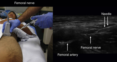 Fig. 31.2, In-plane needle visualization with anechoic anesthetic spread underneath the fascia iliaca.