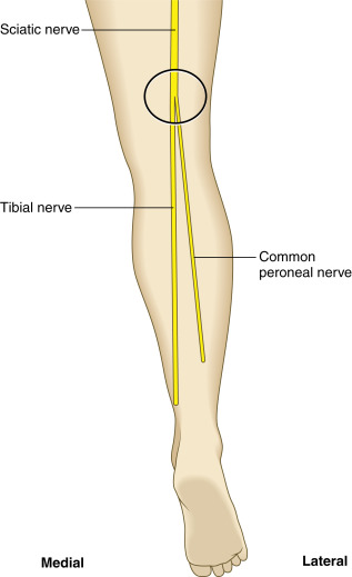 Fig. 31.3, The distal sciatic nerve splits into the tibial and common peroneal nerves just above the popliteal fossa.