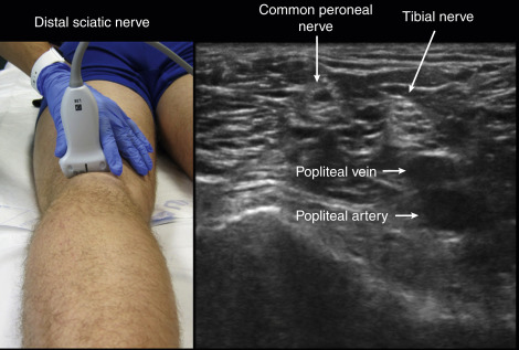 Fig. 31.4, Locate the popliteal artery and vein in the fossa and then note the tibial and common peroneal nerve just superficial.