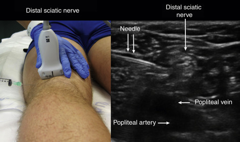 Fig. 31.5, Once the distal sciatic nerve is identified, enter from the lateral approach with in-plane needle visualization. Anesthetic should be placed in close proximity to the distal sciatic nerve.