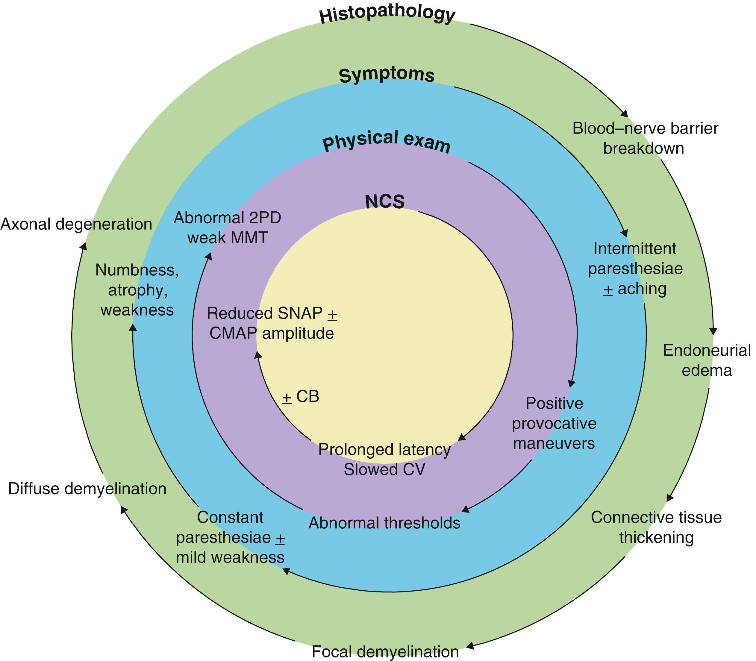 Fig. 54.1, The histopathology of chronic nerve compression and its correlation with symptoms, physical exam and electrodiagnostic findings. 2PD, two-point discrimination; CB, conduction block; CV, conduction velocity; CMAP, compound muscle action potential; MMT, manual muscle testing; NCS, nerve conduction study; SNAP, sensory nerve action potential.