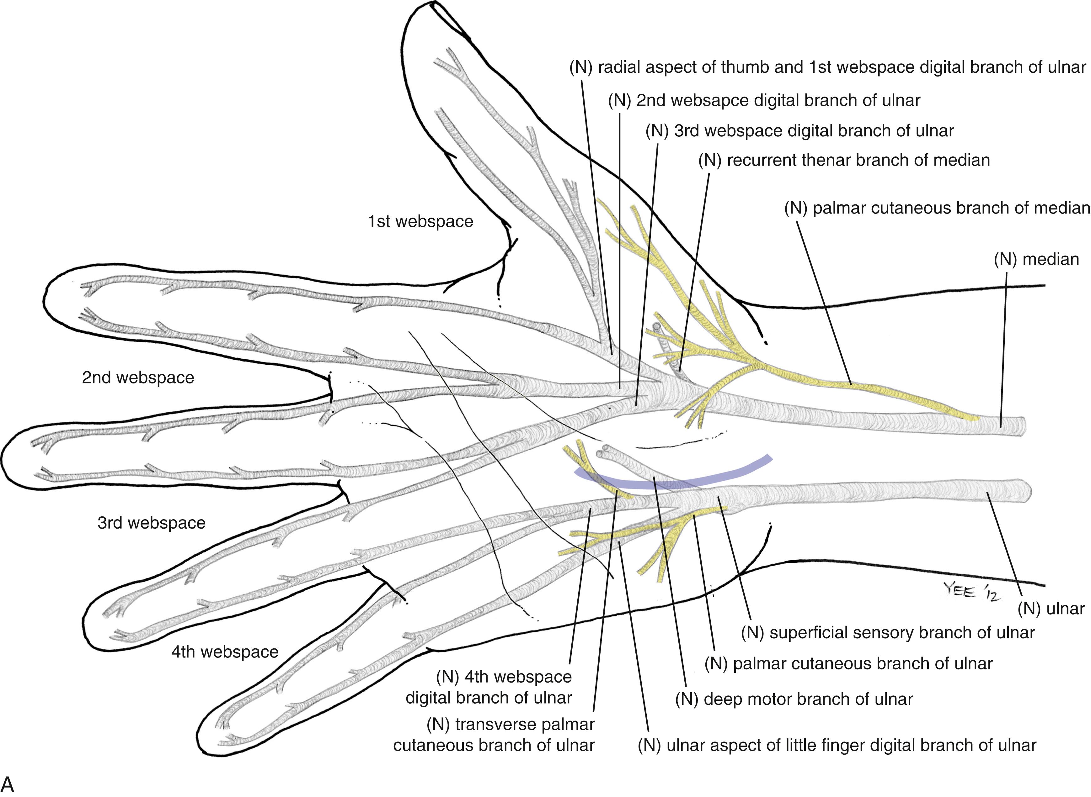 Fig. 54.3 (A–F), Author’s preferred technique for open carpal tunnel release. (A) Relationship of the skin incision to the underlying median and ulnar nerve anatomy.