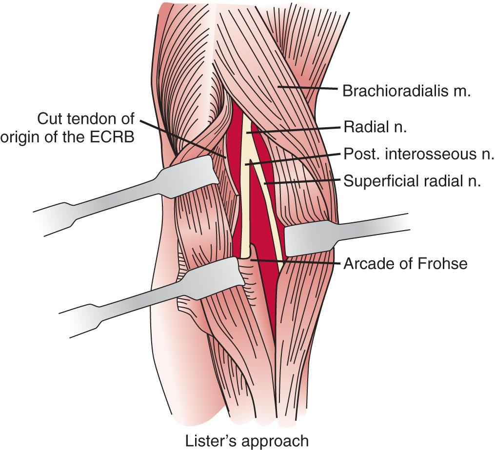 FIG 72.11, An extensile exposure of the forearm to demonstrate the radial nerve may be accomplished by the surgical excisions shown here. The data outlined by Lister may be used to aid in performing an extensile exposure to the radial tunnel. ECRB , Extensor carpi radialis brevis; m. , muscle; n , nerve.