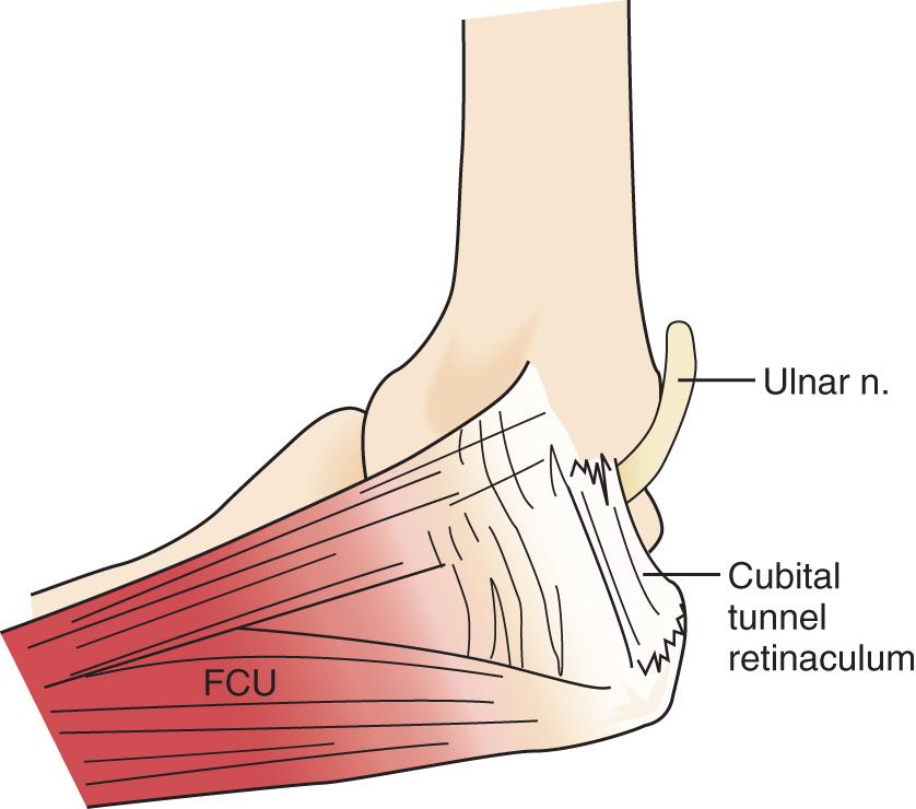 FIG 72.12, The cubital tunnel retinaculum seems to be the predominant site of pathology for patients with primary ulnar nerve symptoms at the elbowf. FCU, Flexor carpi ulnaris; n., nerve.