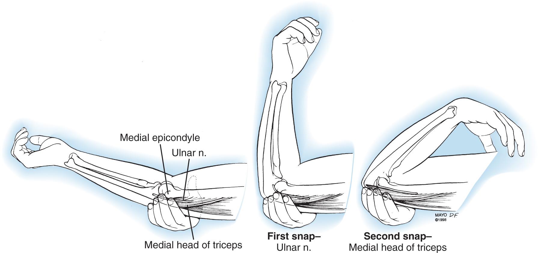 FIG 72.13, The ulnar nerve can be palpated within the cubital tunnel with the elbow in extension. Then with passive or active flexion of the elbow, the examiner can assess whether the ulnar nerve or another structure, such as a portion of the medial head of the triceps or an anomalous triceps tendon, moves anterior to the medial epicondyle. n., Nerve.