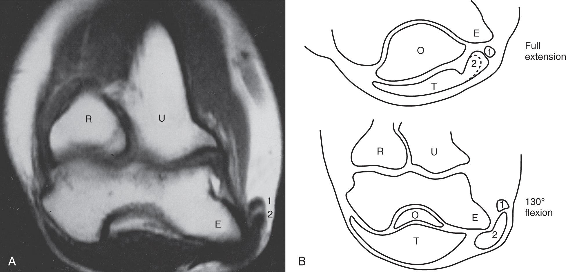 FIG 72.14, (A) Magnetic resonance imaging can demonstrate a snapping triceps and dislocating ulnar nerve. Here the ulnar nerve (1) and a portion of the medial head of the triceps (2) are anterior to the medial epicondyle (E) with the elbow fully flexed. Computed tomography or real-time ultrasonography can also confirm the diagnosis. Imaging, however, is not necessary for confirmation of a diagnosis. Patients undergoing ulnar nerve surgery should be examined preoperatively and intraoperatively, with the elbow in flexion and extension, so that the surgeon can evaluate whether the medial head of the triceps snaps over the medial epicondyle. (B) Corresponding drawing shows the position of the ulnar nerve and the medial head of the triceps to the medial epicondyle in full extension and flexion. O, Olecranon; R, radius; T , triceps; U, ulna.