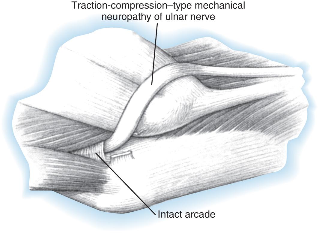 FIG 72.15, Tethering of the ulnar nerve may result from a previous (incomplete) decompression.