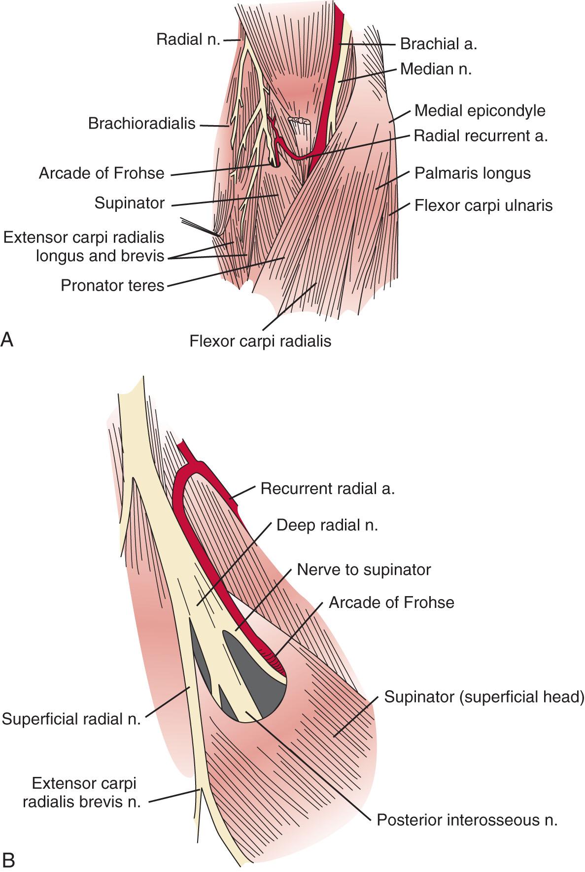 FIG 72.2, (A) Dissection of the anterior aspect of the elbow demonstrating the anatomic relationship with the radial nerve. (B) An enlarged view of the antecubital fossa shows the relationship of the posterior interosseous nerve to the supinator muscle and the arcade of Frohse. Note how the proximal superficial radial nerve is spared from compression by the arcade. a. , Artery; n. , nerve.