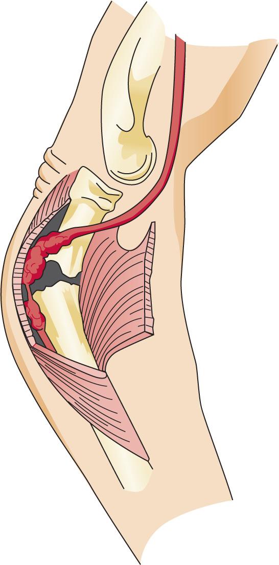 FIG 72.3, Fractures of the proximal radius often demonstrate posterior angulation, which places the posterior interosseous nerve in jeopardy.