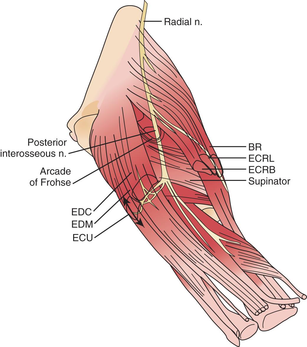 FIG 72.10, Details of the innervation provided by the posterior interosseous nerve. The nerve may be traced to the supinator showing the terminal branches. BR , Brachioradialis; ECRB , extensor carpi radialis brevis; ECRL , extensor carpi radialis longus; ECU , extensor carpi ulnaris; EDC , extensor digitorum communis; EDM , extensor digitorum minimi; n , nerve.