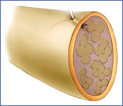 Fig. 14.3, Epineural Suture