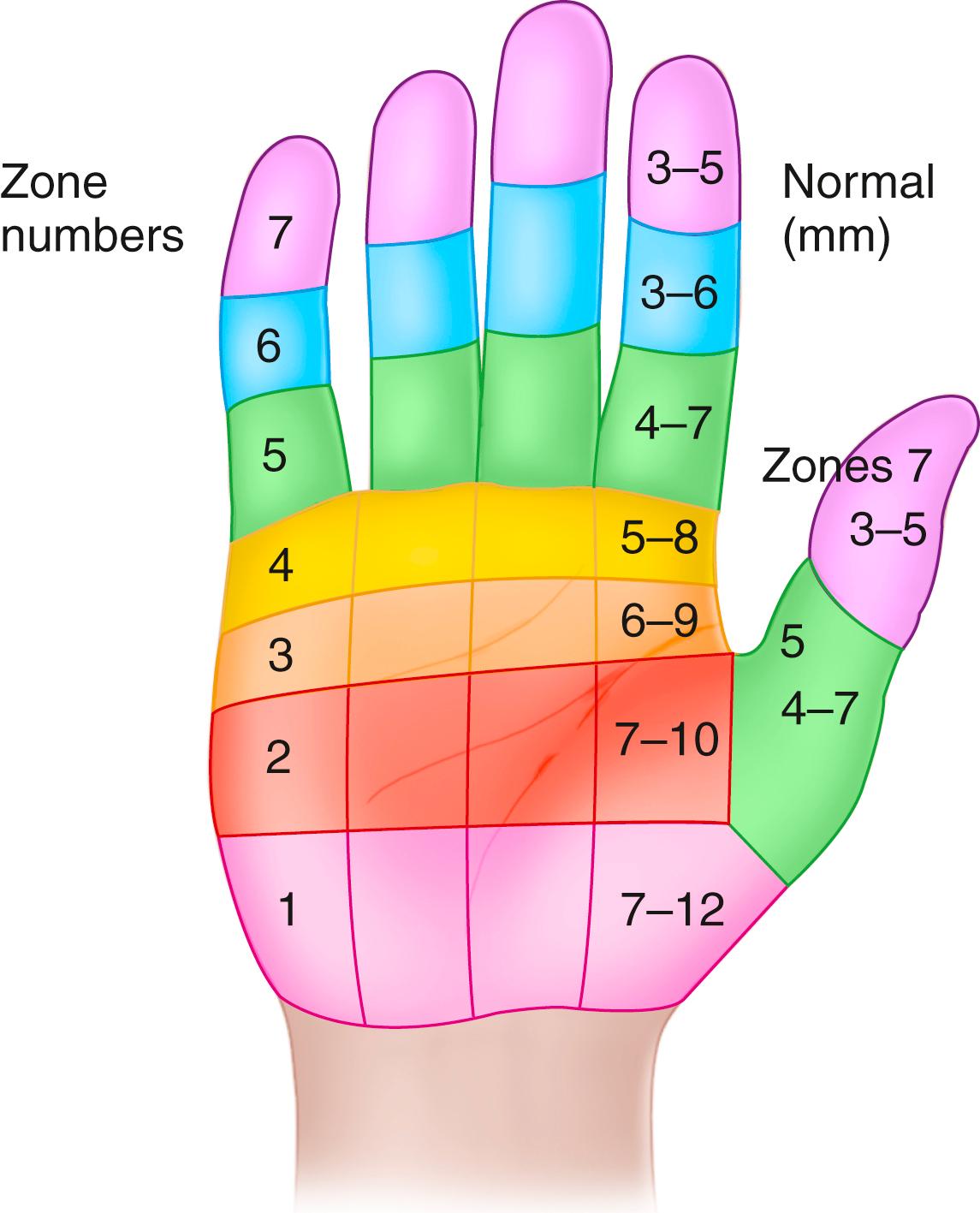 Nerve Injuries at the Level of the Hand and Wrist - Clinical Tree