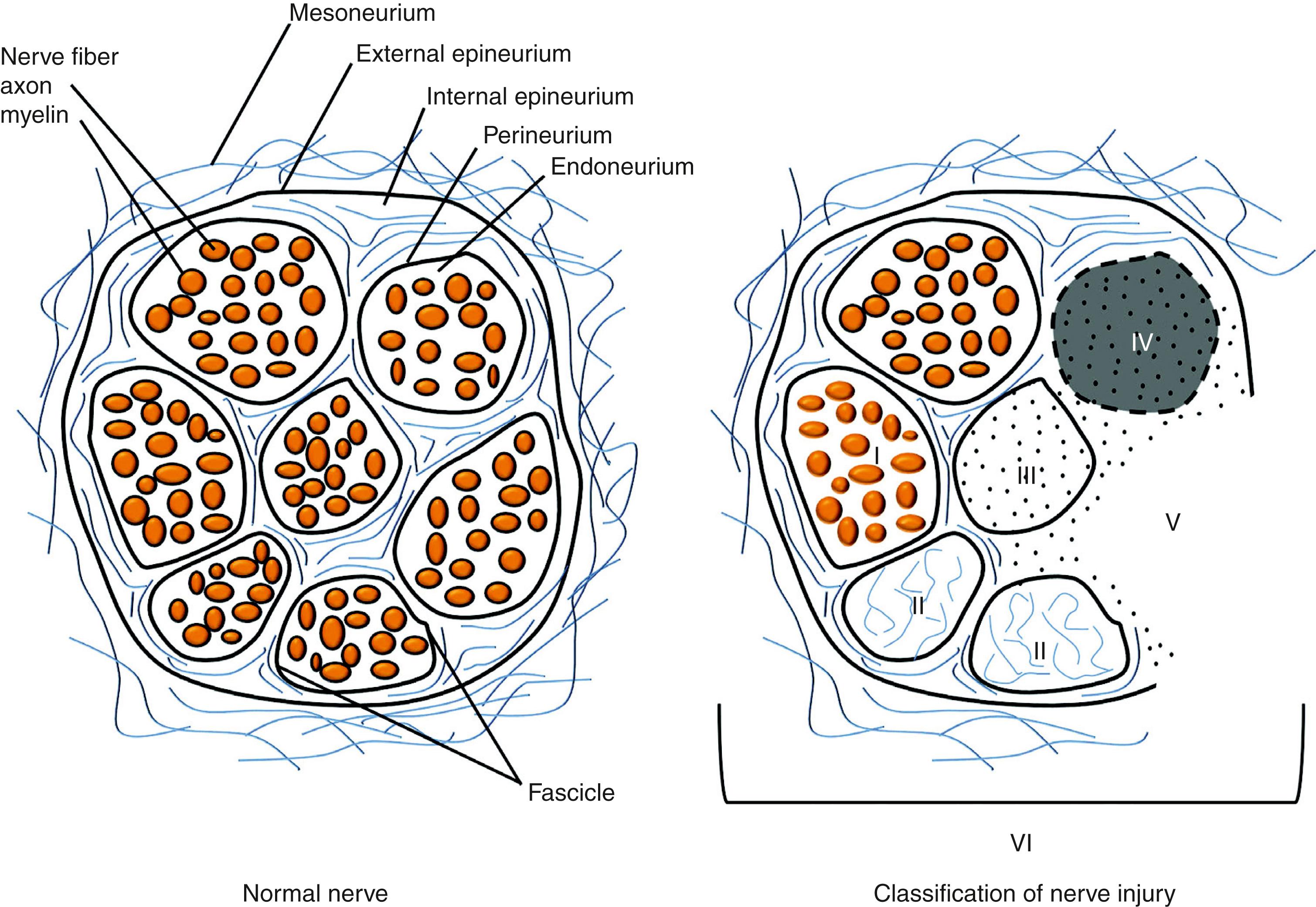 Fig. 52.1, Schematic representation of the cross-section of a normal peripheral nerve showing the connective tissue and nerve tissue components. The cross-section of the peripheral nerve on the right demonstrates a mixed, or sixth-degree, injury pattern. The fascicle at the top left is normal. Moving in a counterclockwise direction, fascicle I is a first-degree injury (neuropraxia) with segmental demyelination. Fascicle II is a second-degree injury (axonotmesis). The second degree involves both the axon and the myelin. The endoneurial tissue is not damaged. Fascicle III demonstrates a third-degree injury, with injury to the axon, myelin, and endoneurium. The perineurium is intact and normal. Fascicle IV demonstrates a fourth-degree injury, with injury to the axon, myelin, endoneurium, and perineurium. The fascicle is marked by scarring across the nerve, with only the epineurium being intact. Fascicle V is a fifth-degree injury in which the nerve is not in continuity and is transected. The surgeon will separate the fourth- and fifth-degree injury patterns, which will require reconstruction from the normal fascicles and the fascicles demonstrating first-, second-, and third-degree injury patterns. These latter patterns of injury require, at most, neurolysis.