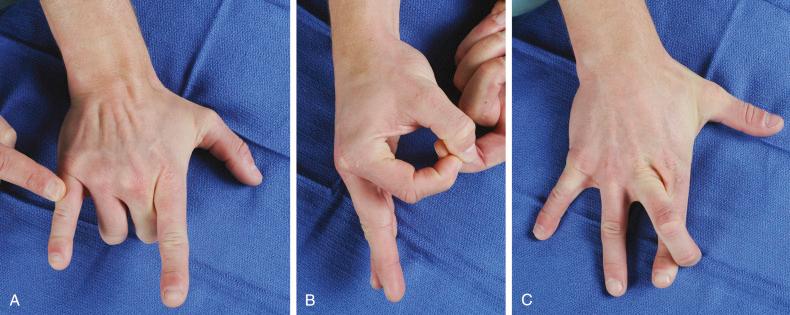 Fig. 8.3, Favorite tests for nerve function. (A) Hook ’em horns for posterior interosseous nerve (radial nerve). (B) OK sign for anterior interosseous nerve (median nerve). (C) Crossing fingers (ulnar nerve).