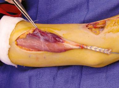 Fig. 8.4, Biceps muscle demonstrating innervation of the anterior portion and denervation of the posterior portion.