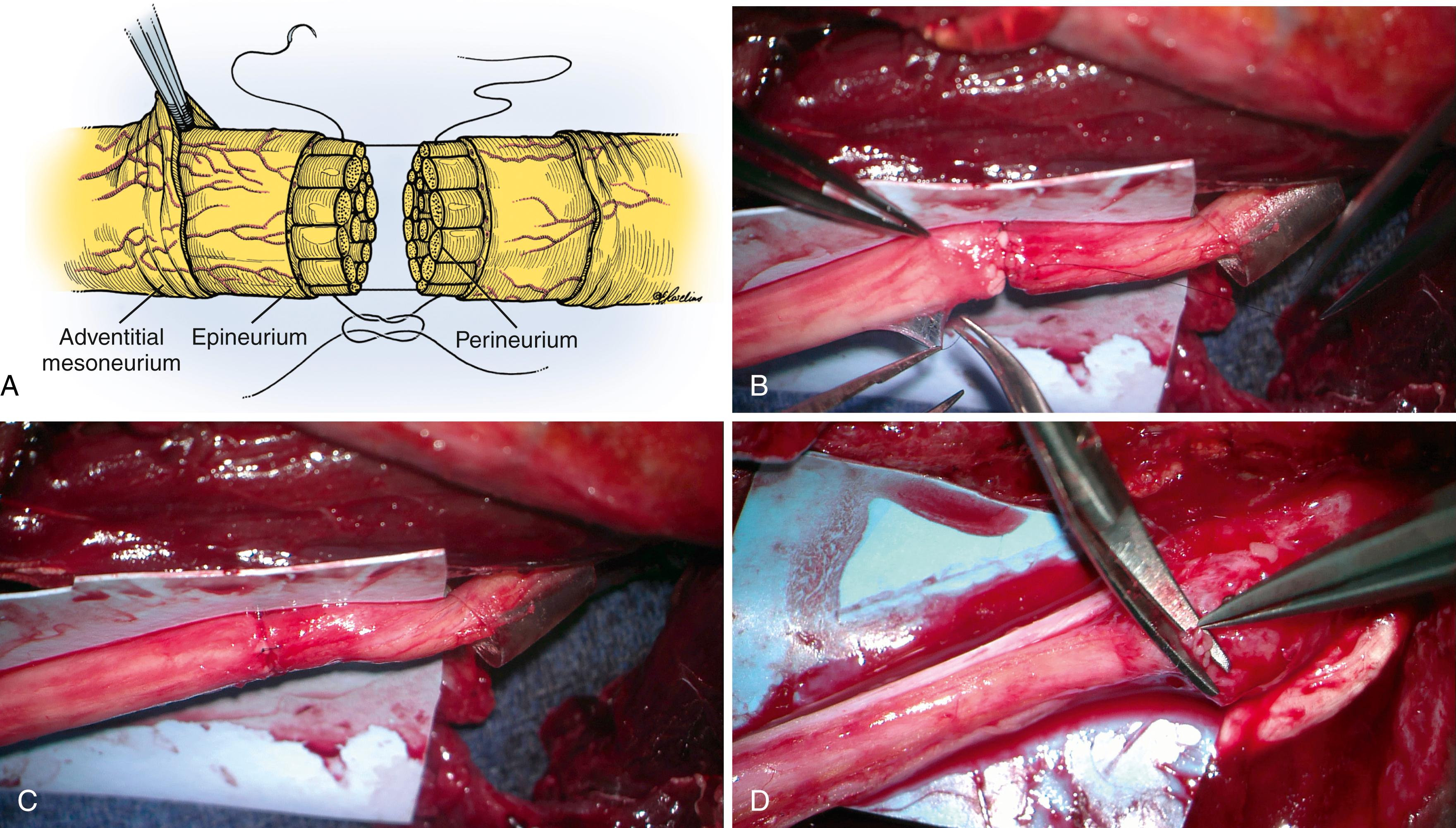 Fig. 30.11, A, Schematic showing nerve alignment and suture placement. B, Controlling depth of needle penetration and placement and tying suture so that tissue is barely approximated will allow exact fascicular alignment. C, Suture is tied so that the ends are barely touching without fascicular overlap. Note the connector on the nerve trunk that can be slid over the repair. D, Any fascicles overlapping or “pooching” out of coaptation can be trimmed back.