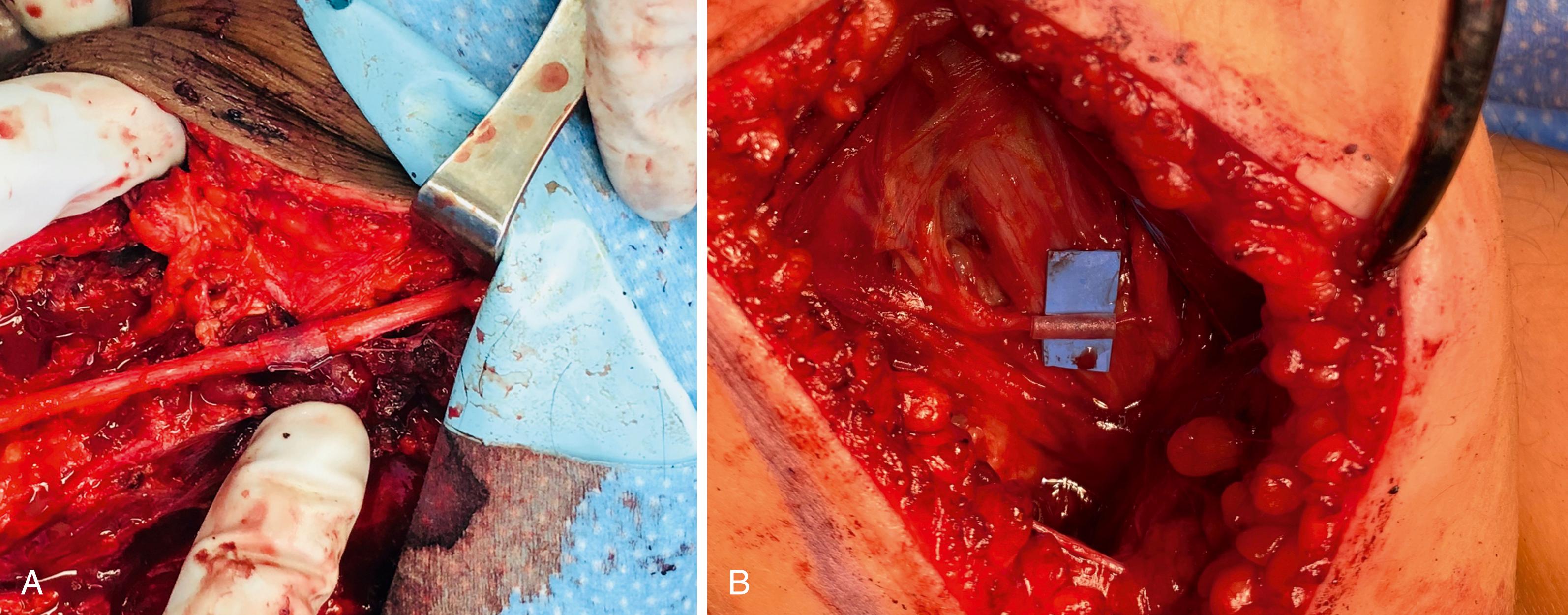 Fig. 30.13, Nerve connectors applied around coaptations. A, Oversized connector slid over repair. Hemo-clips taking out the “slack” and sutures placed through the ends to hold the connector in place and “unload” the repair. B, Connector has been slit and wrapped around the coaptation. The surface tension may hold the wrap closed. Alternatively, sutures or fibrin glue can offer more security.