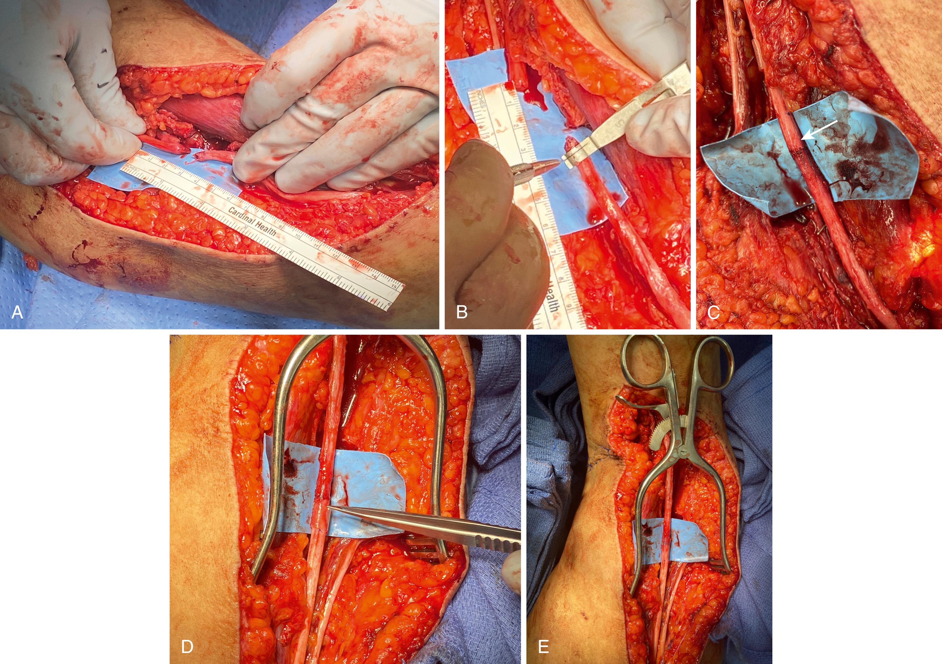 Fig. 30.14, A median nerve laceration from a stab wound to the distal brachium. Despite the sharp transection, after several days, the nerve ends have retracted, and mobilization and gentle traction is necessary to get the ends to grossly approximate. A, After mobilization, the ends can be brought together. B, Minimal resection is necessary to reveal healthy fascicular patterns. C, Mild elbow flexion is necessary to alleviate all tension so a “protective” 6-0 Prolene stitch has been placed across the repair. Group epineurial sutures obtain alignment. The nerve connector has been placed on the nerve trunk and slid out of the way for the repair. D, The connector is slid over the repair and sutured in place (E) .