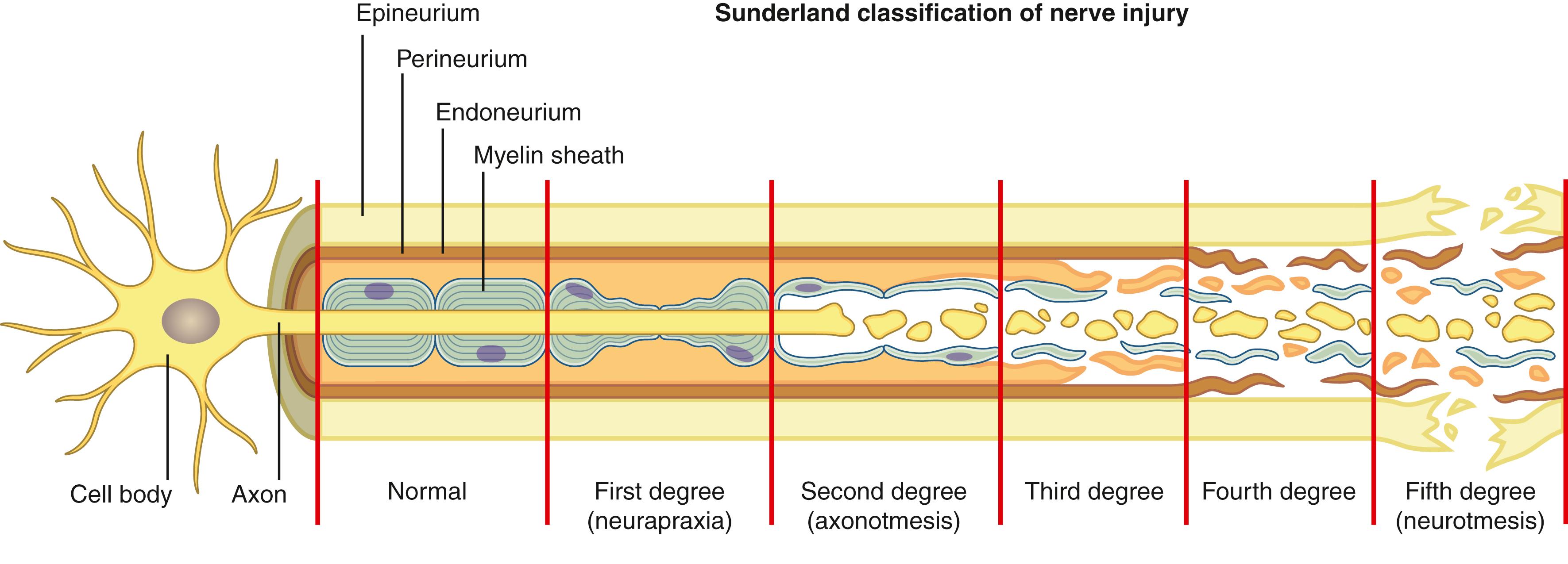 Fig. 30.3, The Sunderland classification describes progressively more severe nerve injuries based on the sequential disruption of connective tissue layers. Third-, fourth-, and fifth-degree injuries generally require surgical reconstruction.