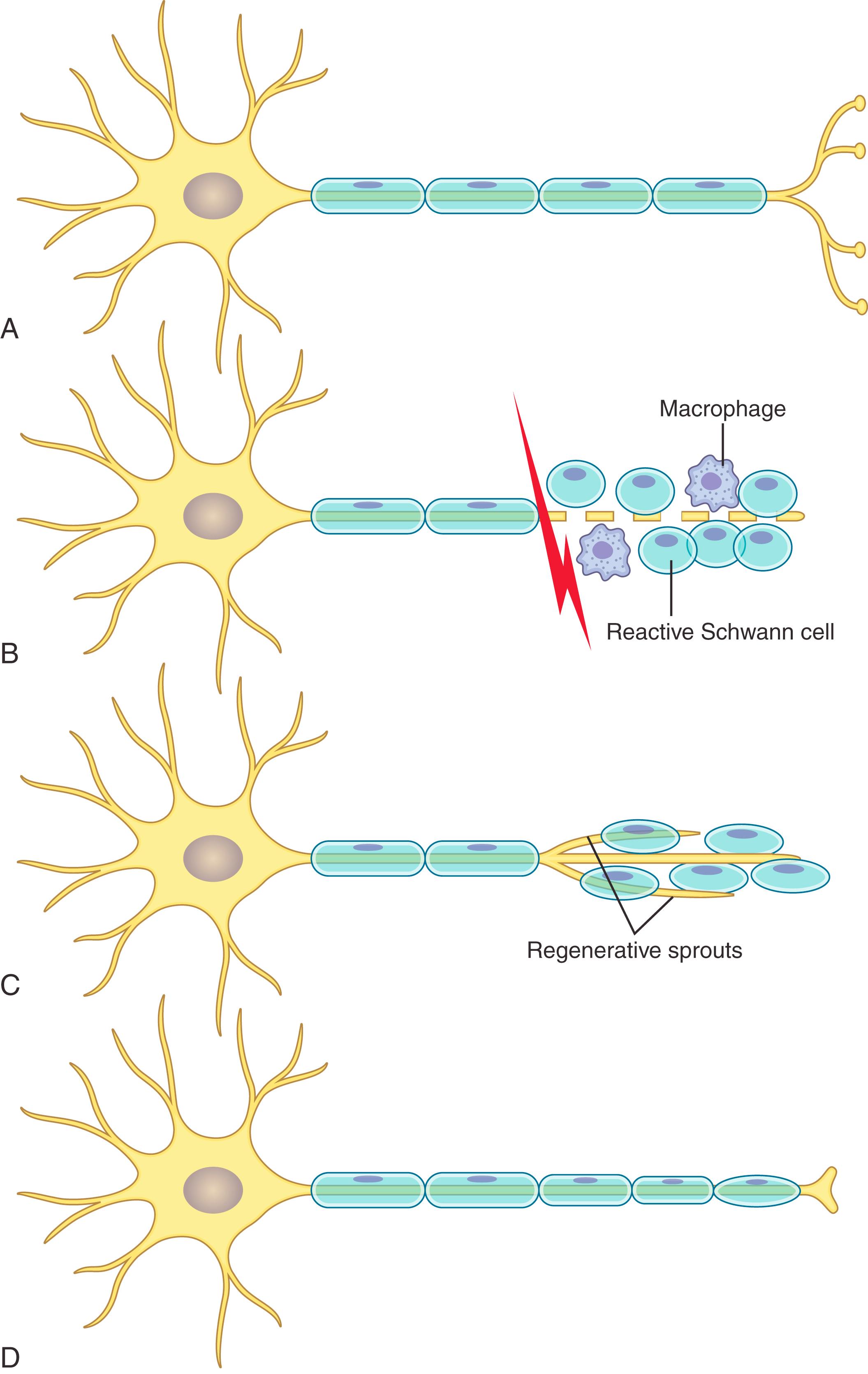 Fig. 30.4, Degeneration and regeneration of a myelinated axon. Following disruption of a myelinated axon (A) , the axon distal to the injury will fragment and phagocytic Schwann cells and macrophages will remove the degenerated cellular debris from the distal endoneurial tube (B) . If endoneurial tube alignment has been preserved (Sunderland II to III injuries) or surgically reestablished (Sunderland III to V injuries), the Schwann cells within the enduneurial tube will organize and guide regenerating axon sprouts (C) . The axonal sprout that successfully reaches its target will mature and undergo remyelination (D) .