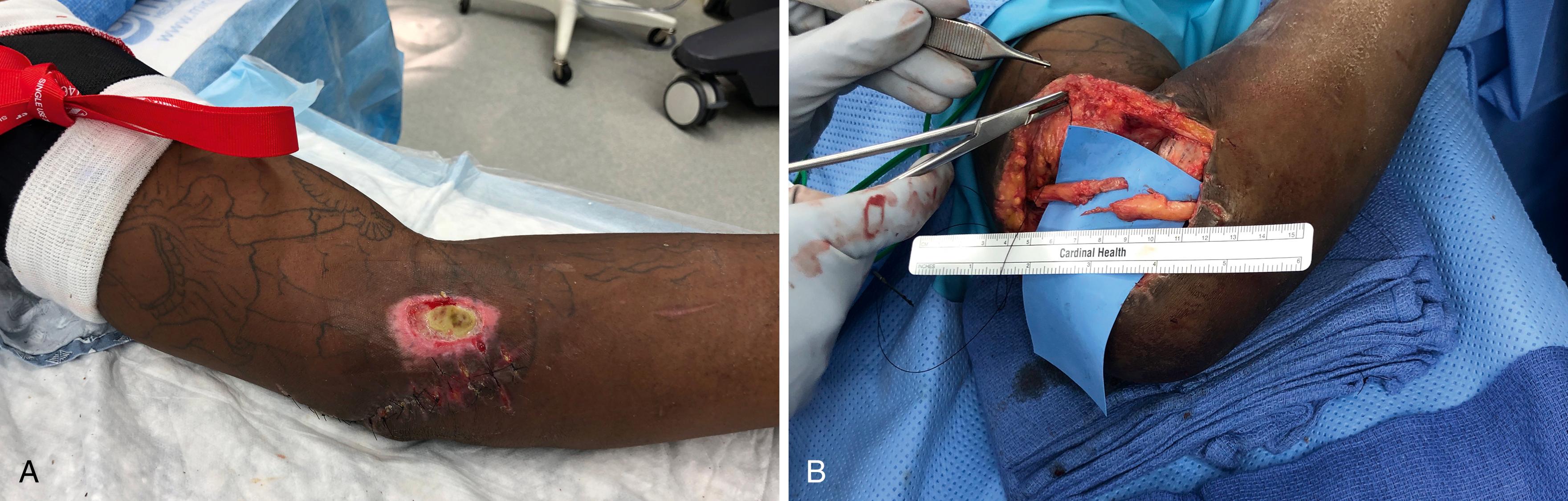 Fig. 30.6, A patient presented with an ulnar nerve deficit after a motor vehicle accident. A, The traumatic wound was treated at an outside facility but is relatively benign in appearance. B, Exposure of the ulnar nerve (and status post-mobilization and anterior transposition) reveals a much larger zone of injury than anticipated.