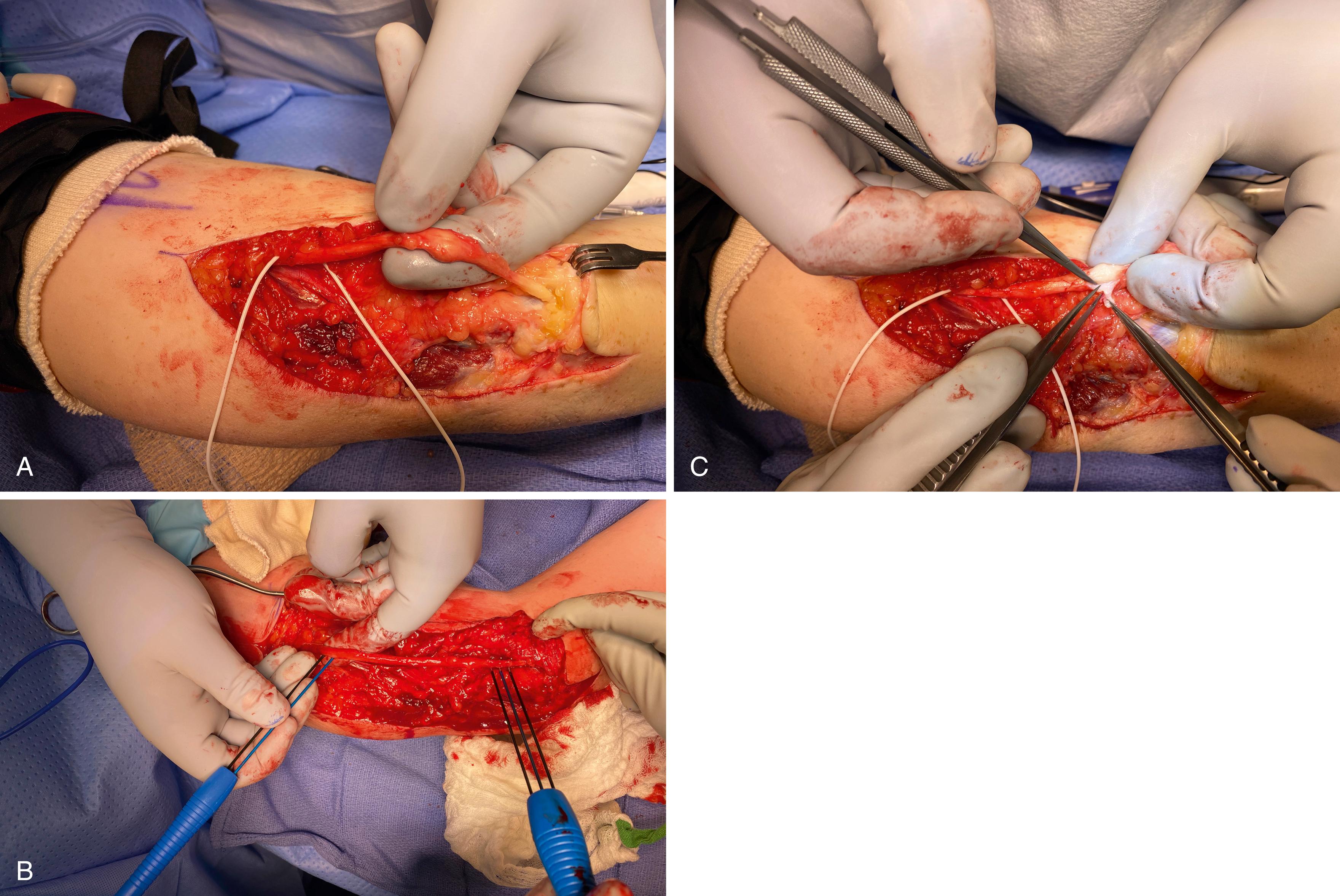 Fig. 30.7, Intraoperative assessment of ulnar nerve neuroma-in-continuity fails to demonstrate physiologically viable nerve tissue. A, Tactile inspection of the neuroma-in-continuity reveals a firm, scarred mass not compatible with healthy nerve tissue. B, Stimulating and recording electrodes placed proximal and distal to the neuroma for direct nerve conduction study. C, Fibrotic epineurium is peeled away but reveals intraneural scar tissue (not fascicles).